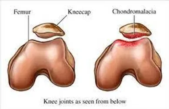 Kondromalazi Patella Belirtileri