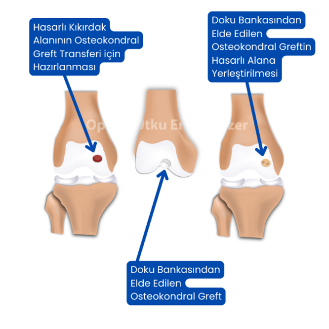 Osteokondral Allogreft Nakli
