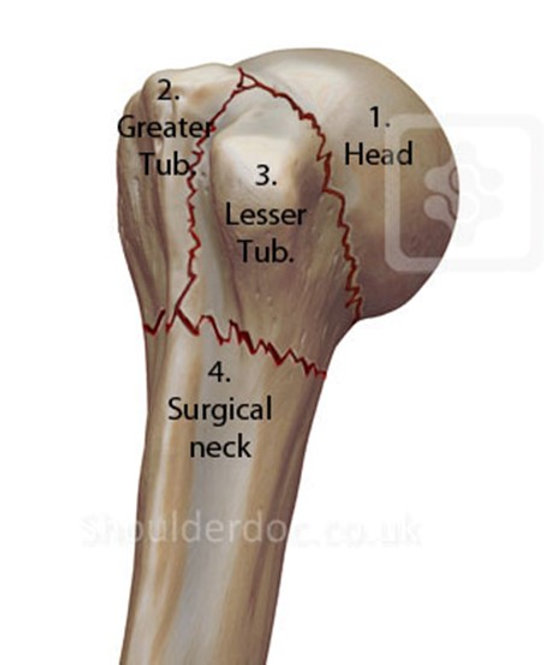 Humerus Üst Uç Kırığı Çeşitleri