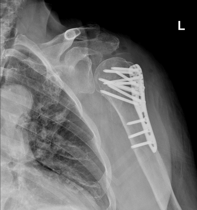 Humerus Üst Uç Kırığı Ameliyatı