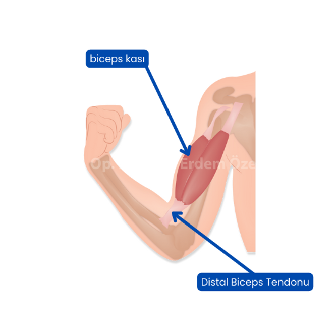 Dirsekte Distal Biceps Yaralanması