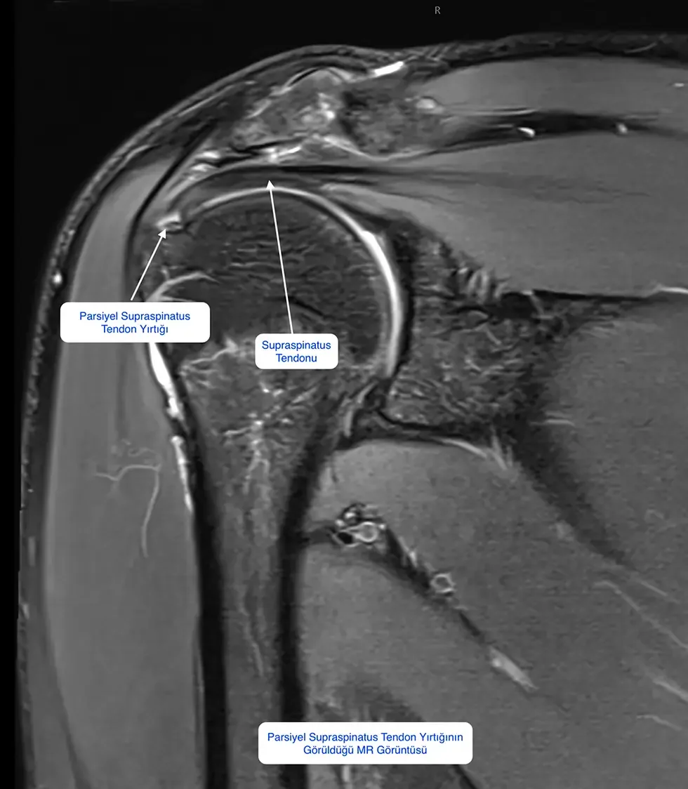 Parsiyel Supraspinatus Tendon Yırtığı MR Görüntüsü