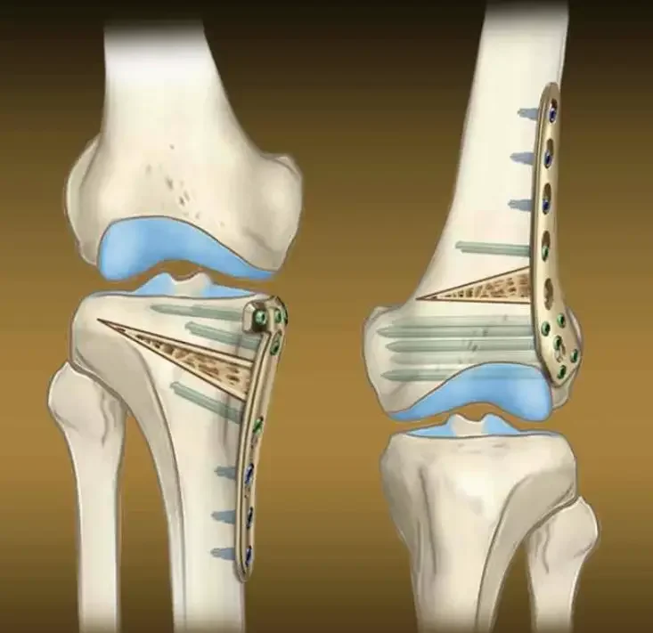 Diz Çevresindeki Eğriliklerin Tedavisi: Yüksek Tibial Osteotmi ve Distal Femoral Osteotomi