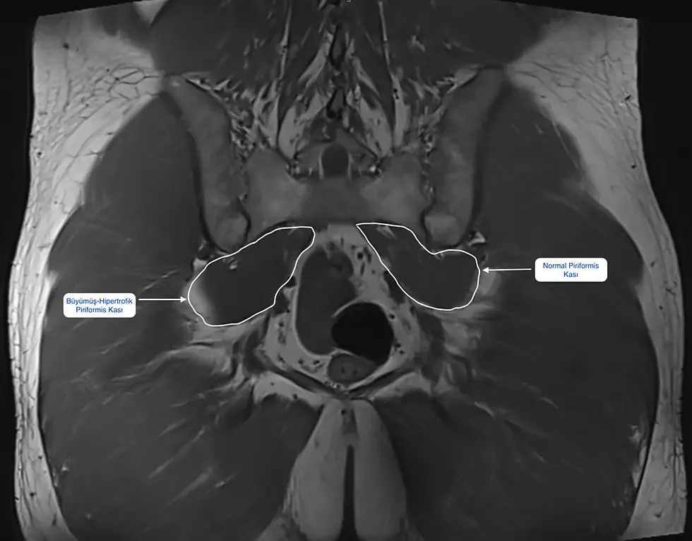Piriformis Sendromu MR Görüntüsü