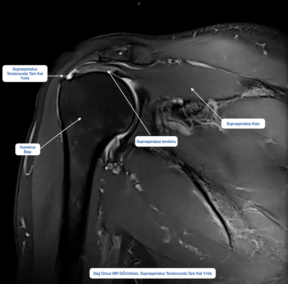 Tam Kat Supraspinatus Tendon Yırtığı MR Görüntüsü