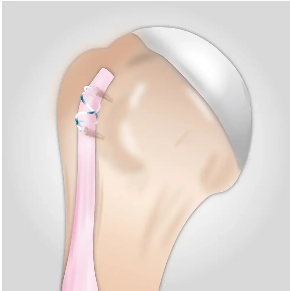 biceps tendon ağrısı