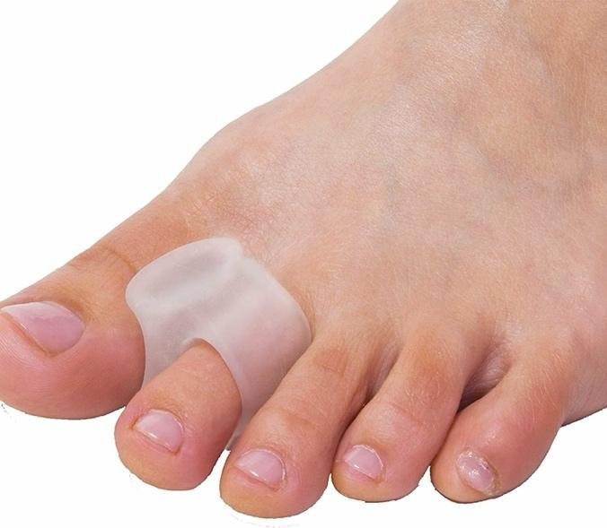 halluks valgus nedir