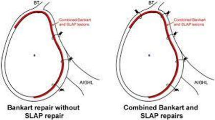 omuz labrum yırtığı belirtileri