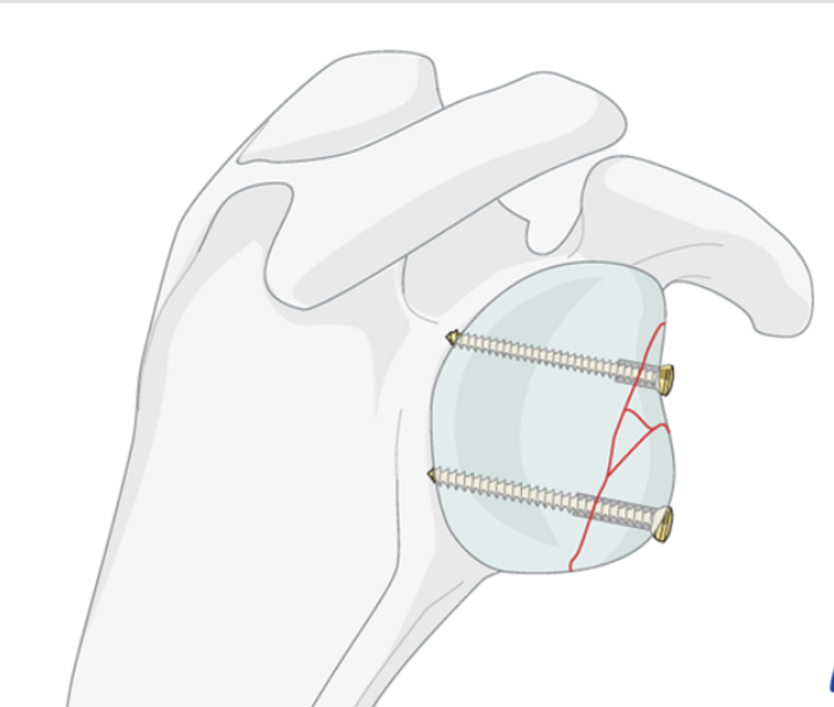 Glenoid Omuz Çıkığı Ameliyatı